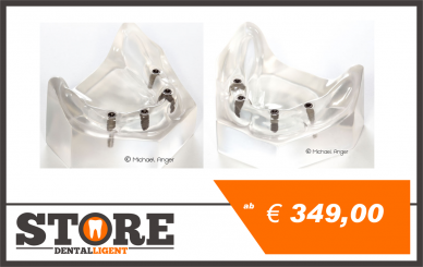 Demo model of clear acrylic with 4 implants 