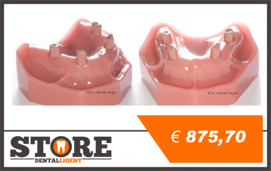 OK Modell mit 4 Implantaten und 4 Abutments in Rosa PEEK 