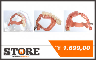 Acryl-Modell mit PEEK-Teleskopen und Modellguss, halbseitig mit Konfektionszähnen fertiggestellt. 