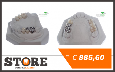 Gipsmodell mit Brücken aus Zirkon und NEM 14-16 & 24-26 keramische Verblendung 4er vollverblendet, 5er vestibulär 