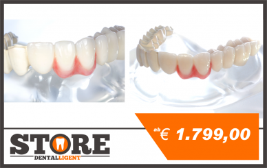 acrylic model with telescopic bridge from tooth-colored PEEK, one side veneered with composite. 