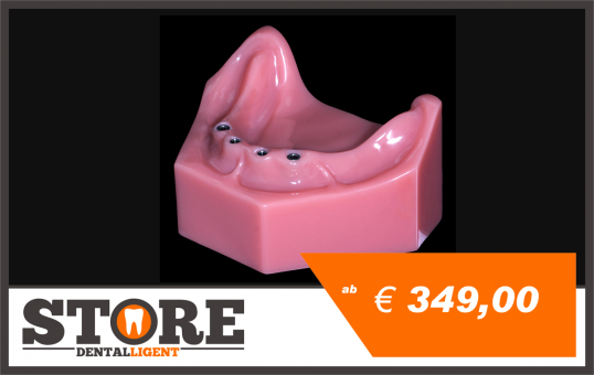 Lower Jaw model with 4 implants in pink acrylic without abutments 