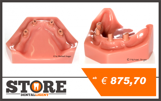 Lower Jaw model with 4 implants and abutments as telescopes from Pink PEEK. 